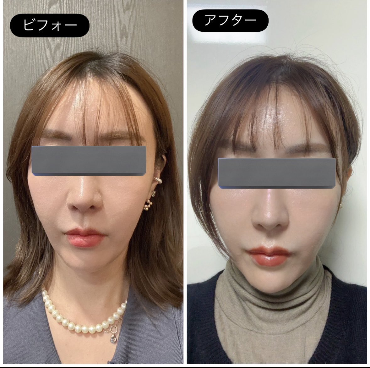 L90030086F's tweet photo. 🧵 糸リフト翌日のリアル経過レポ

「糸リフトって傷跡どんな感じ？」って
質問多いから、
リアルな状態そのまま載せておくね🫶

📸 これは翌日の状態
傷跡は“ほんの少し赤みがある程度”で、
テープを貼っているからほぼ目立たないよ。

痛みもそこまで強くなくて、
洗顔・スキンケアも普段通りほぼOK！
（もちろん擦らないようにだけ注意♡）

糸リフトって“バレやすそう”って
思われがちだけど、
実際はこんな感じで 至近距離じゃないと
分からないレベル。
髪を下ろしてたら本当に気付かれないと
思う🙆‍♀️

私は ダウンタイム最小重視 だったから、
この仕上がりは正直めちゃくちゃ満足✨

✨ 【糸リフト Before → After】 ✨
※フィラーなし／糸だけでここまで変わる♡

正直…
想像以上の仕上がりすぎてびっくりした🥹✨
中顔面のもたつき・
ほうれい線の影がふわっと薄くなって、
“疲れて見える印象”が本当に軽くなったの。

📍 BVクリニック@BVclinicjp 

ここ…本当に穴場レベルで良かった…！！

まず先生のカウンセリングが 圧倒的に丁寧。
顔の癖・脂肪のつき方・左右差まで
全部見てくれて、
「どう引き上げると1番綺麗に見えるか」を
すっごく具体的に説明してくれるタイプ。

施術中もとにかくやさしくて、
違和感が出た瞬間に声かけて調整してくれる。
こういう “繊細系の糸リフト”は本当に誰に任せるかで仕上がりが変わる。

✦ 術後の感想
・腫れはほんのり
・翌日には普通にお出かけ可能
・ナチュラルに引き上がってるのに
鏡を見るとちゃんと変化ある
・“やりました感ゼロ”で、
ただただスッキリ若返る👏

✦ Before / After の変化（写真見てほしい…！）
・ほうれい線の影が薄く
・中顔面がキュッと短く見える
・フェイスラインが軽くなって小顔効果
・全体的に“顔の重さ”が取れて若見え

初めて糸リフトする人にも、
ナチュラル仕上がりが好きな人にも
本気でオススメ♡