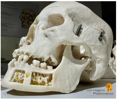 #Bones demonstrate even the most delicate of features and landmarks, including the: wafer-thin #laminapapyracea, delicate #pterygoidhamulus, nutrient and neural #foramina, and grooves for #vessels and #nerves.

Real Anatomy for Teaching (Learning) by von Hagens Plastination