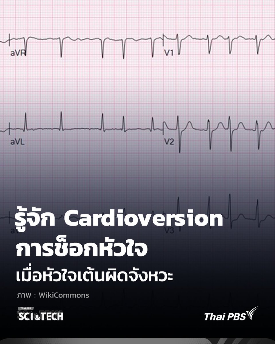 ThaiPBSSciTech's tweet image. รู้จัก #Cardioversion #การช็อกหัวใจ เมื่อ #หัวใจเต้นผิดจังหวะ

📌อ่านต่อ : thaipbs.or.th/now/content/34…

--------------------------
🌏 “รอบรู้ ดูกระแส ก้าวทันโลก” ไปกับ #ThaiPBSSciAndTech #Science #วิทยาศาสตร์ #ThaiPBS thaipbs.or.th/SciandTech