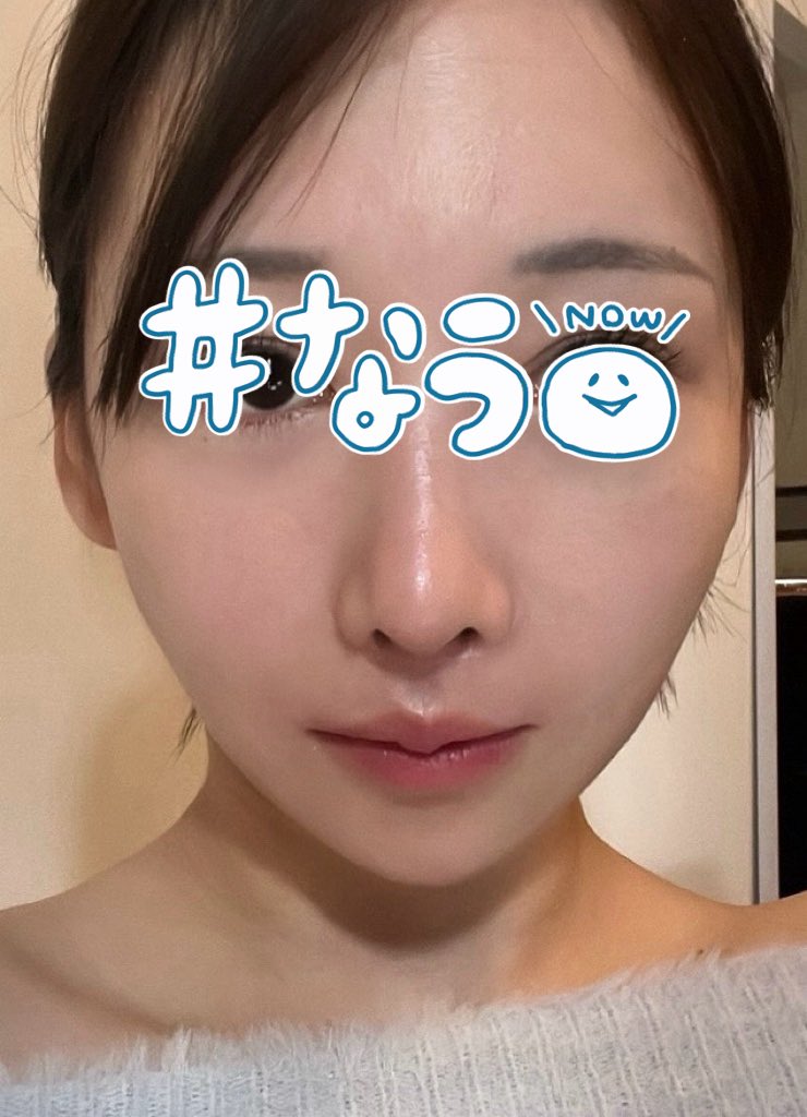 17dsy_'s tweet photo. ウルセラして5日経過！

加工とか化粧って言われそうだけど両方すっぴん無加工。※左肌荒れ過ぎ
ハイフ含め引き上げ施術は沢山やってきたけど今回が1番引き上がってる。
鼻横の影も消えて、輪郭のもたつきも改善🥺

@doctorsjapan で300shot打ったよ。
部位ごとに凄く考えながら先生が打ってくれる。 https://t.co/enIu3nreqV