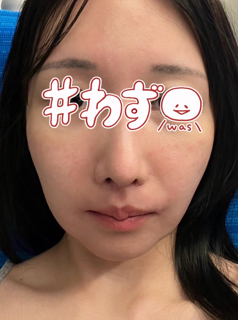 17dsy_'s tweet photo. ウルセラして5日経過！

加工とか化粧って言われそうだけど両方すっぴん無加工。※左肌荒れ過ぎ
ハイフ含め引き上げ施術は沢山やってきたけど今回が1番引き上がってる。
鼻横の影も消えて、輪郭のもたつきも改善🥺

@doctorsjapan で300shot打ったよ。
部位ごとに凄く考えながら先生が打ってくれる。 https://t.co/enIu3nreqV
