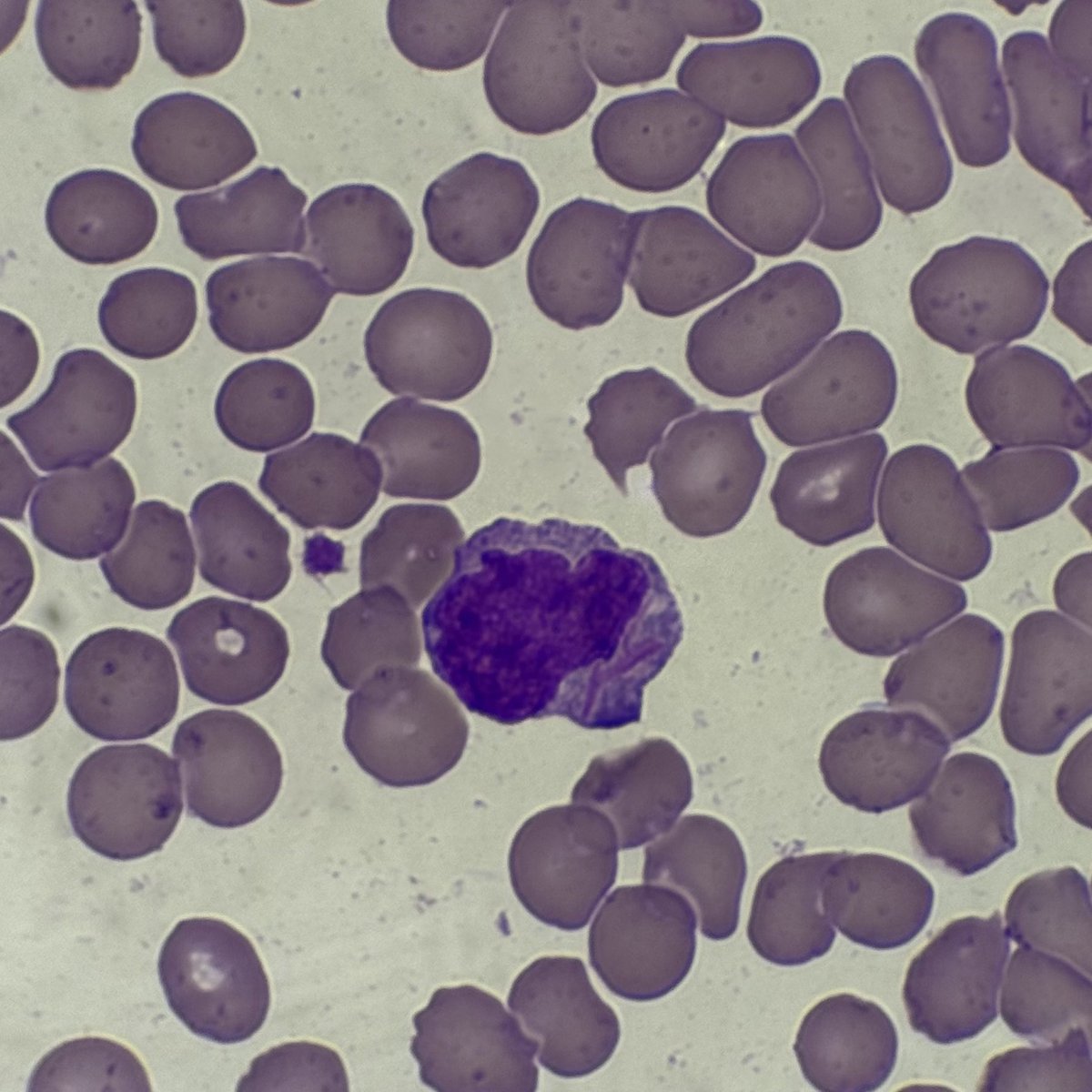 okay_nyx's tweet photo. Faaaaaak!
Sa dami ng binabasa kong smears, di na ako umabot. Very treatable lang sana itong Acute Promyelocytic Leukemia. Nakakadurog ng puso. 😭
#APL #APML https://t.co/dgdamcyb0u