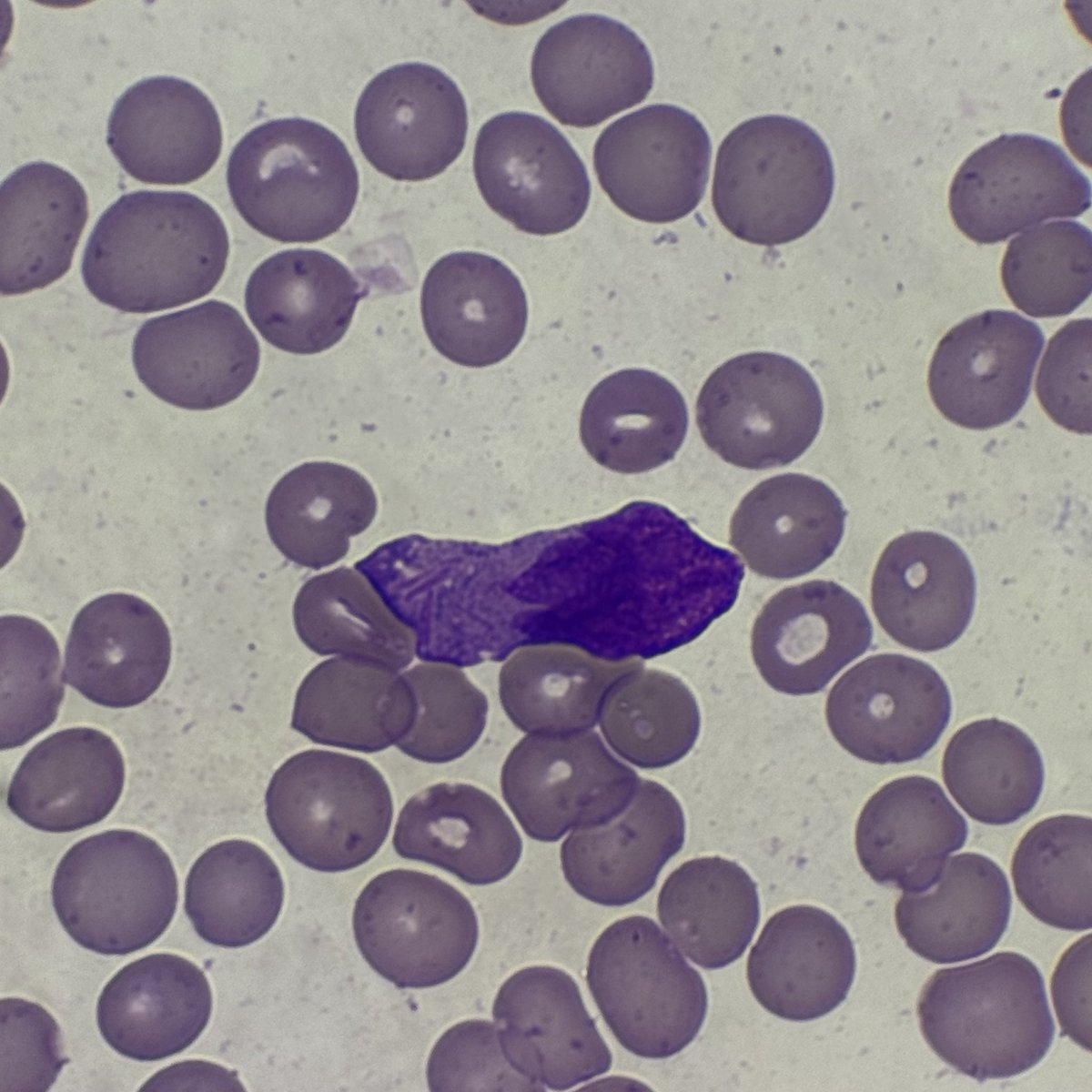 okay_nyx's tweet photo. Faaaaaak!
Sa dami ng binabasa kong smears, di na ako umabot. Very treatable lang sana itong Acute Promyelocytic Leukemia. Nakakadurog ng puso. 😭
#APL #APML https://t.co/dgdamcyb0u
