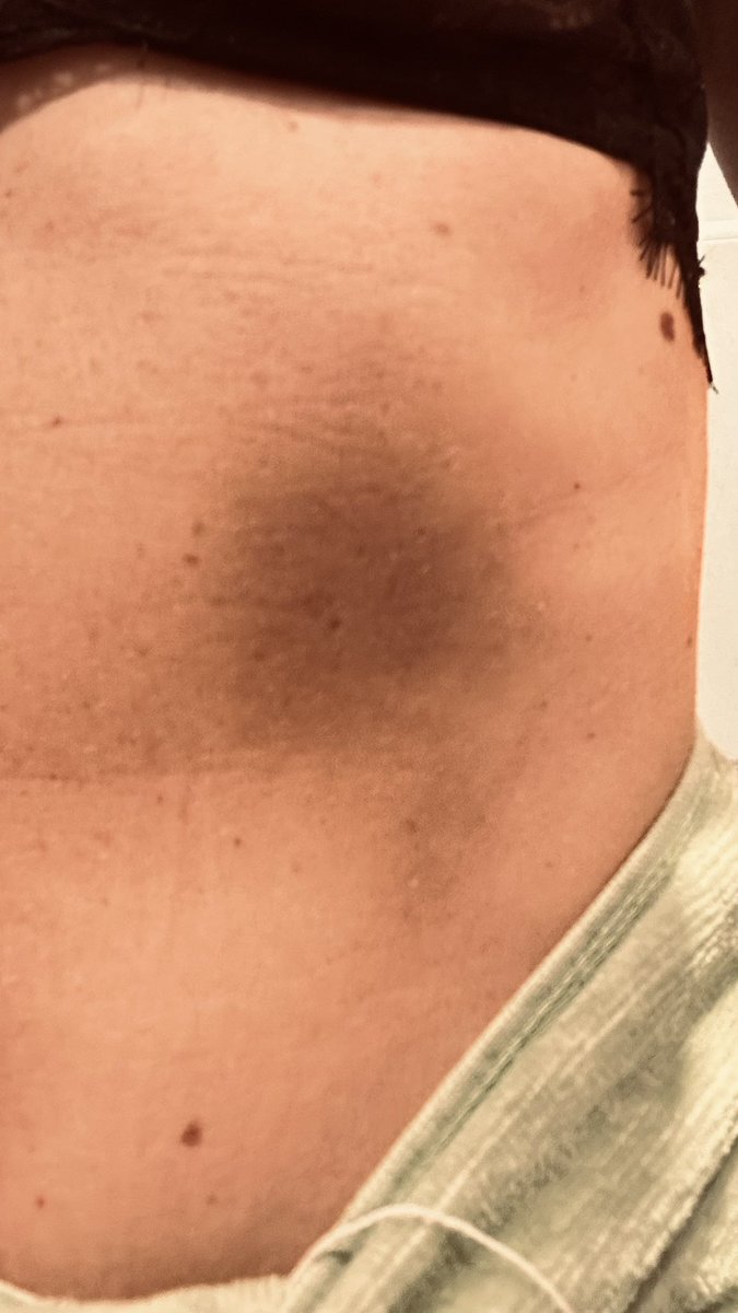 A week after 1st chair and pole routine my ribs still suffering 😵‍💫😱 #polekisses