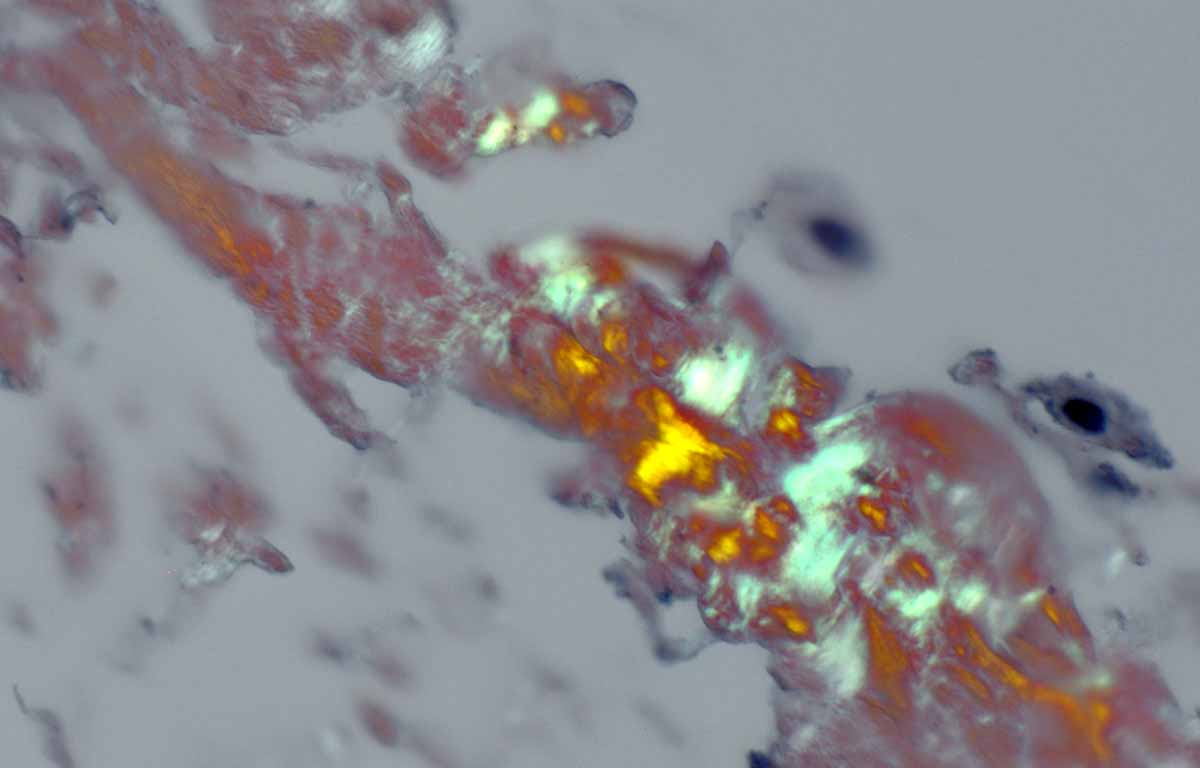 Amyloid deposition is common in patients with carpal tunnel syndrome, surprisingly so in this recent series.  These images are of a Congo red stain, one using polarized light and showing apple green birefringence.

PMID: 41345990.