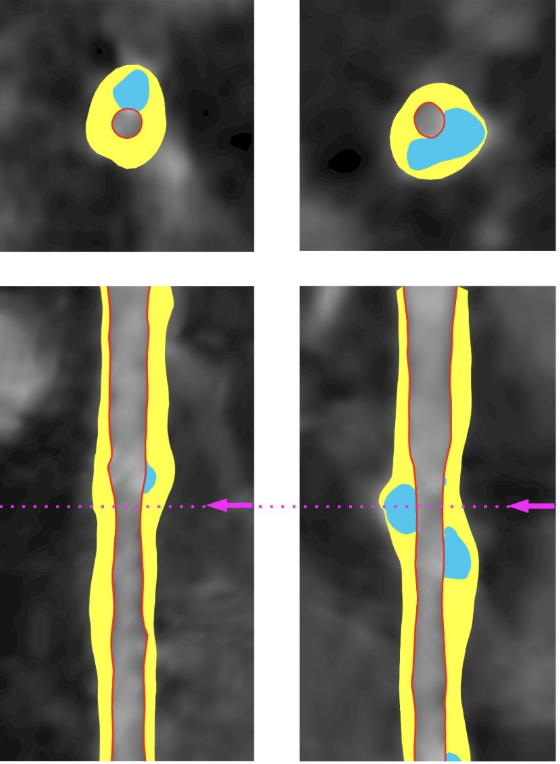 urotoday's tweet photo. Coronary artery plaque progression after ADT in men with #ProstateCancer: a randomized controlled trial comparing relugolix vs leuprolide #REVELUTION. Presentation by @sagarapatel @WinshipAtEmory. #SUO25 written coverage by @zklaassen_md @GACancerCenter on UroToday > https://t.co/xjGrM5vSdl @UroOnc