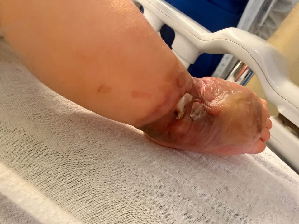 MillyMendezpr's tweet image. Dpto de Salud va a investigar la denuncia que hizo una madre alegando negligencia médica. Su bebé de 5 meses entró por una bronquiolitis y se encontró con este escenario.