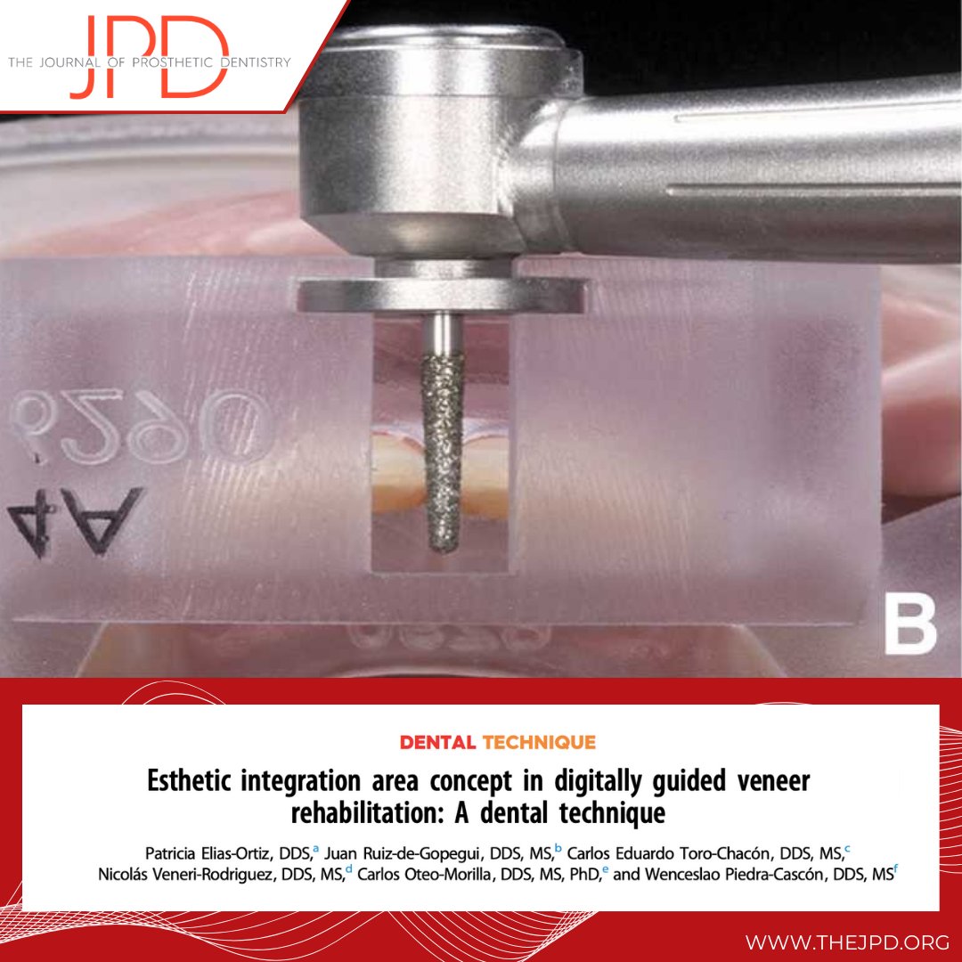 JPDentistry's tweet image. The #latestontheJPD #dentaltechnique describes a step-by-step #digitalworkflow to plan, design, and additively manufacture 3D templates for fully guided maxillary ceramic veneers from dental preparation to cementation in the same clinical appointment. thejpd.org/article/S0022-…