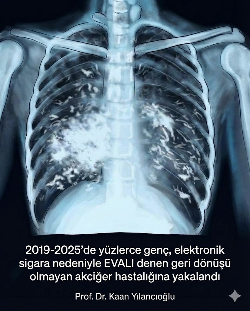 Elektronik sigara (vaping) kullanan binlerce kişide EVALI (E-cigarette or Vaping Associated Lung Injury) oluştu! 

Yıllar önce zararlı yapmayın! Dediğimde nasıl linç edildiğimi hatırlıyorum... 

Adı: EVALI (E-cigarette or Vaping Associated Lung Injury)
ABD’de 2019-2020 arasında