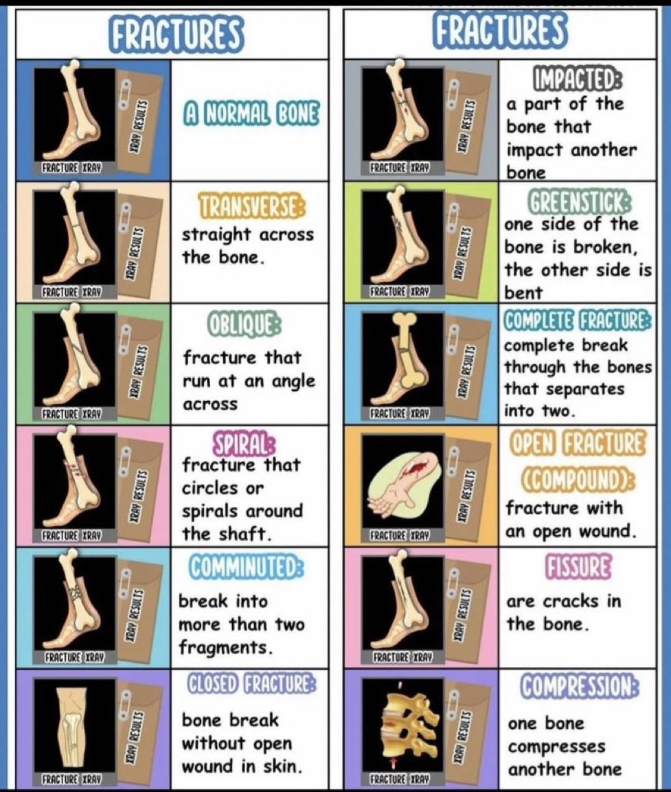👨🏻‍⚕️ صورة طبية جميلة توضح أنواع الكسور التي تصيب الإنسان 🦴