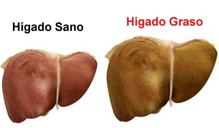 Esto es exactamente lo que haría si tuviera hígado graso.

No me metería pastillas.
No haría una dieta de moda.
No esperaría a “ver si mejora solo”.
Aquí los 8 pasos que aplicaría sin excusas (y por experiencia médica real):          🧵