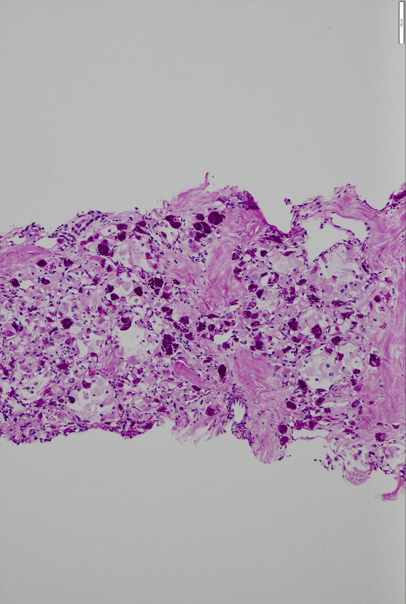 JDCo2pock's tweet photo. Prominent intracytoplasmic crystals on PAS-D stain in alveolar soft part sarcoma (ASPS). TFE3 rearranged. Only the third I have seen.  #BST #SoftTissue #Pathology #BSTpath https://t.co/5Mp93Ud40A