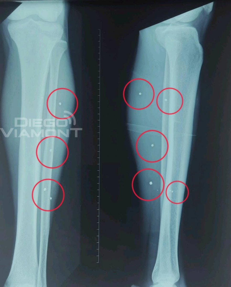 APOYEMOS AL POLICÍA.

UN POLICÍA DEL GRUPO DELTA FUE QUIEN DISPARÓ EN COTAPACHI 

▶️El efectivo policial confesó que sacó su arma y realizó los disparos en defensa propia. Se trata del mismo policía que está internado con disparos de escopeta, tenía más de 20 perdigones en sus