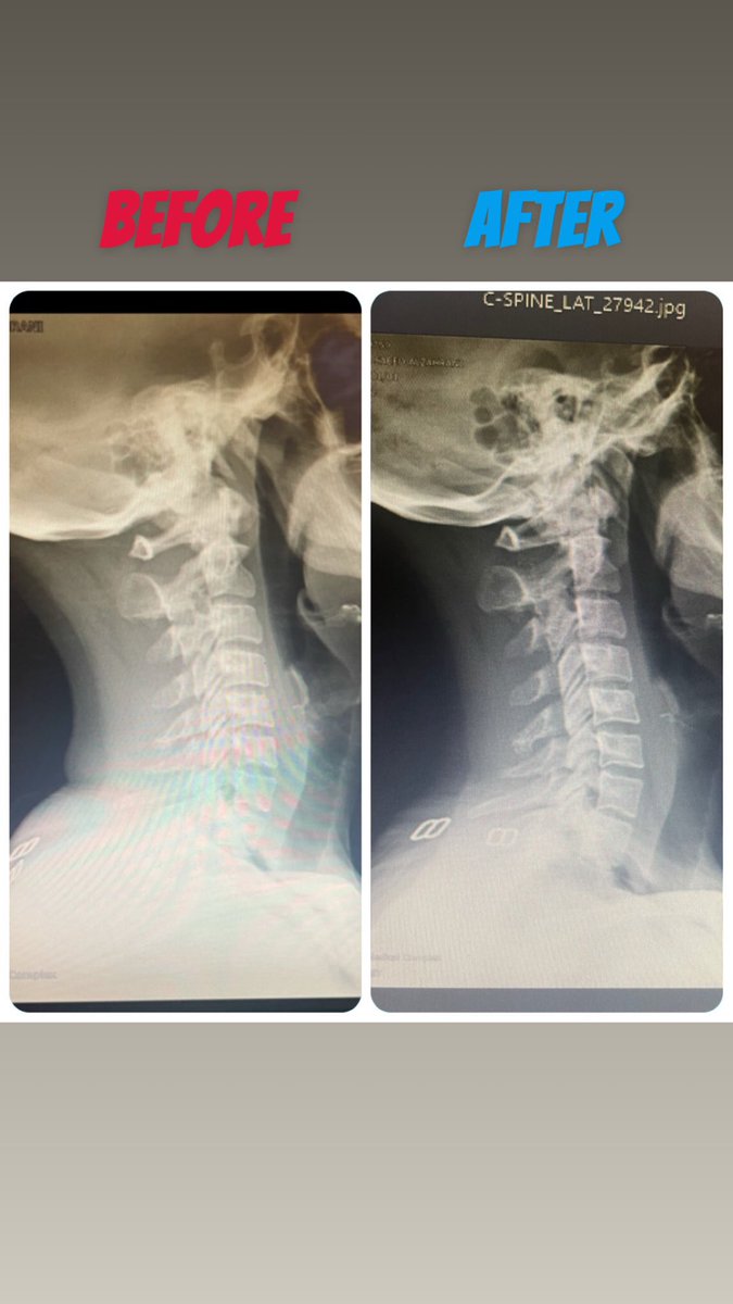 Afrah11209's tweet photo. It’s been only one month, and I’ve noticed that my patient has started making progress in her cervical curvature, and now she has no symptoms or pain. I’m planning to measure it soon
Its the power of Biomechanics 🦾 https://t.co/qEiDkwugNJ