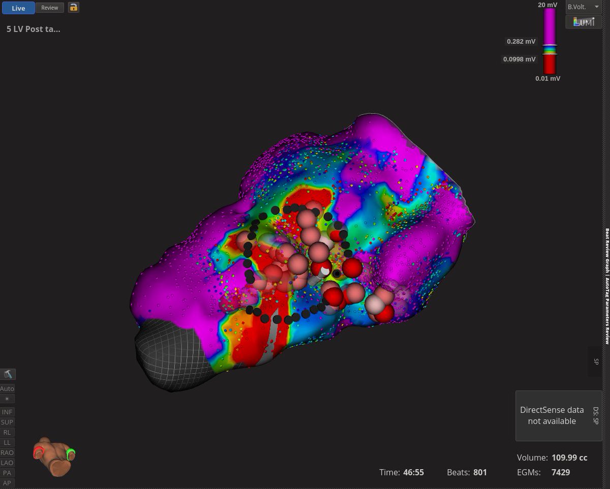 odbobin's tweet image. 2 months ago in EP lab: 72 yo patient inferolateral MI. ICD. Syncopal VT (RBBB). Activation and voltage LV map: continuous diastolic electrical activity (VT);fragmented EGM (SR). RF ablation in this area and RF lines towards the dense scar: VT non-inducible. He remains free of VT