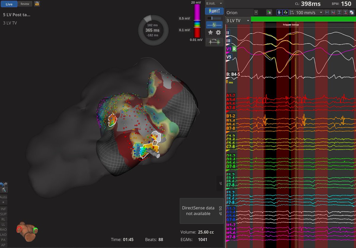 odbobin's tweet image. 2 months ago in EP lab: 72 yo patient inferolateral MI. ICD. Syncopal VT (RBBB). Activation and voltage LV map: continuous diastolic electrical activity (VT);fragmented EGM (SR). RF ablation in this area and RF lines towards the dense scar: VT non-inducible. He remains free of VT