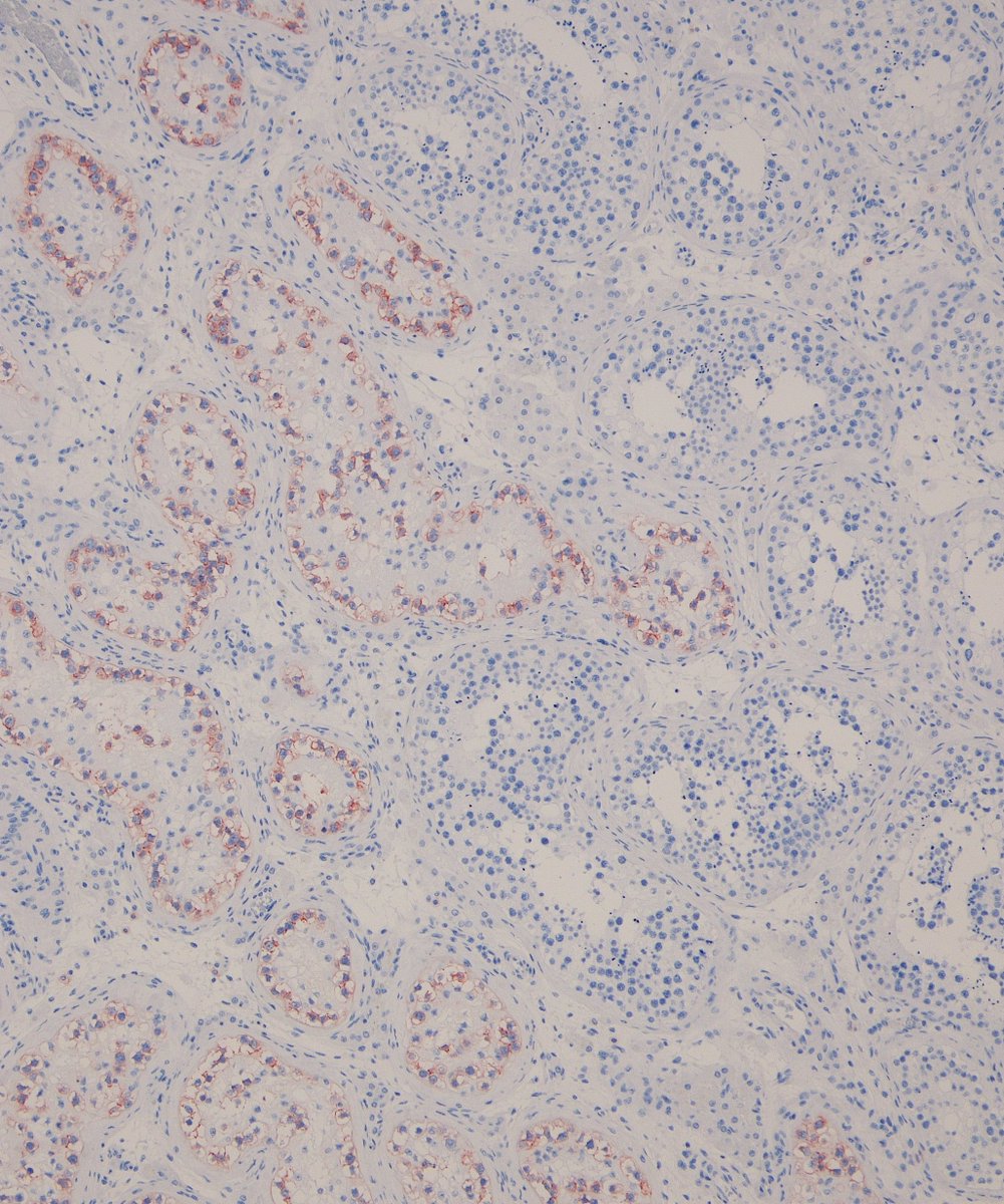 #IHCPath Overexpression of CD117 in germ cell neoplasia in situ (GCNIS) versus normal seminiferous tubules.

#PathTwitter #GUPath