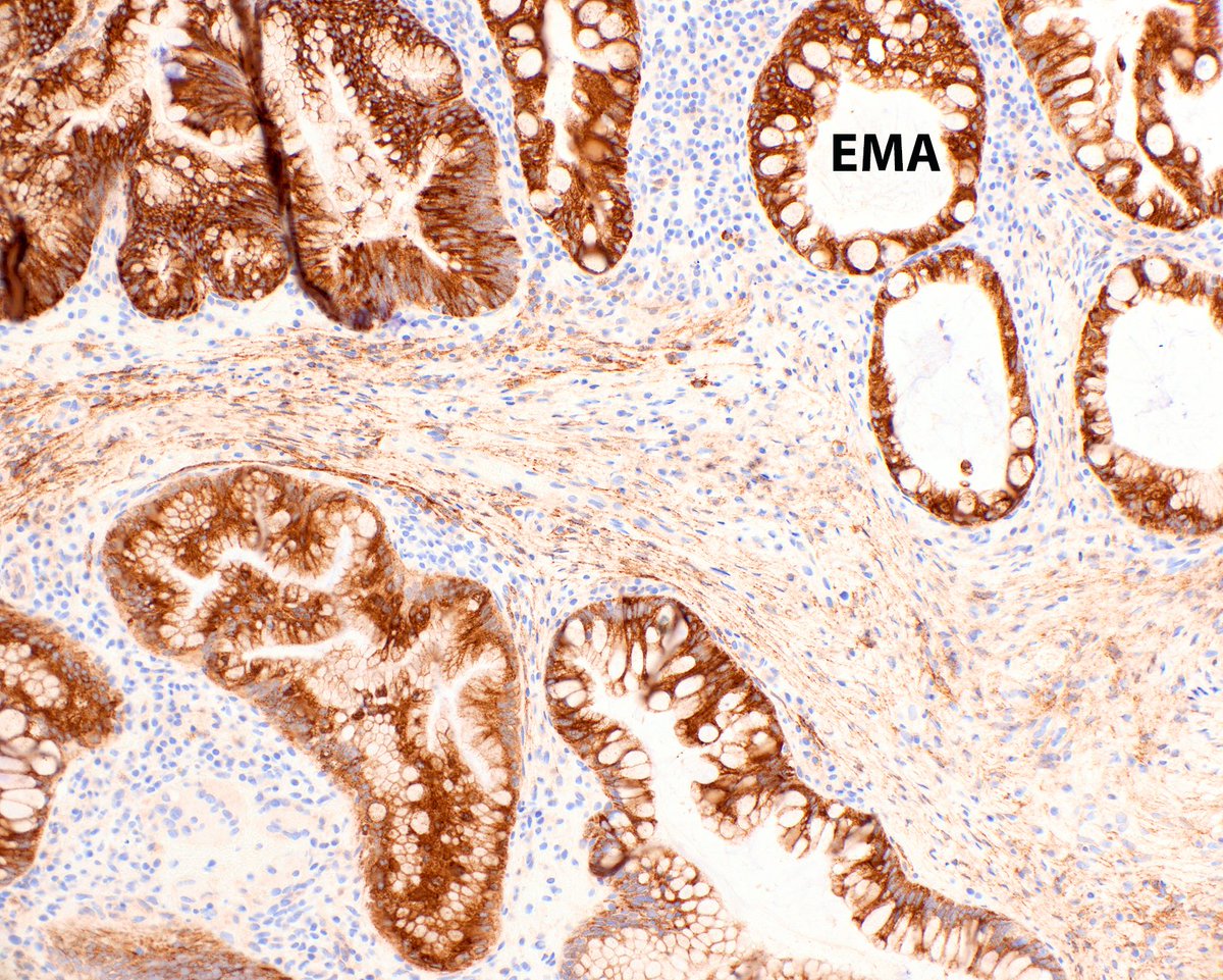This sessile serrated adenoma (polyp, lesion) has dysplasia with loss of MLH1 (the case about half the time) and an associated benign perineurial proliferation.  What more can a gal ask?