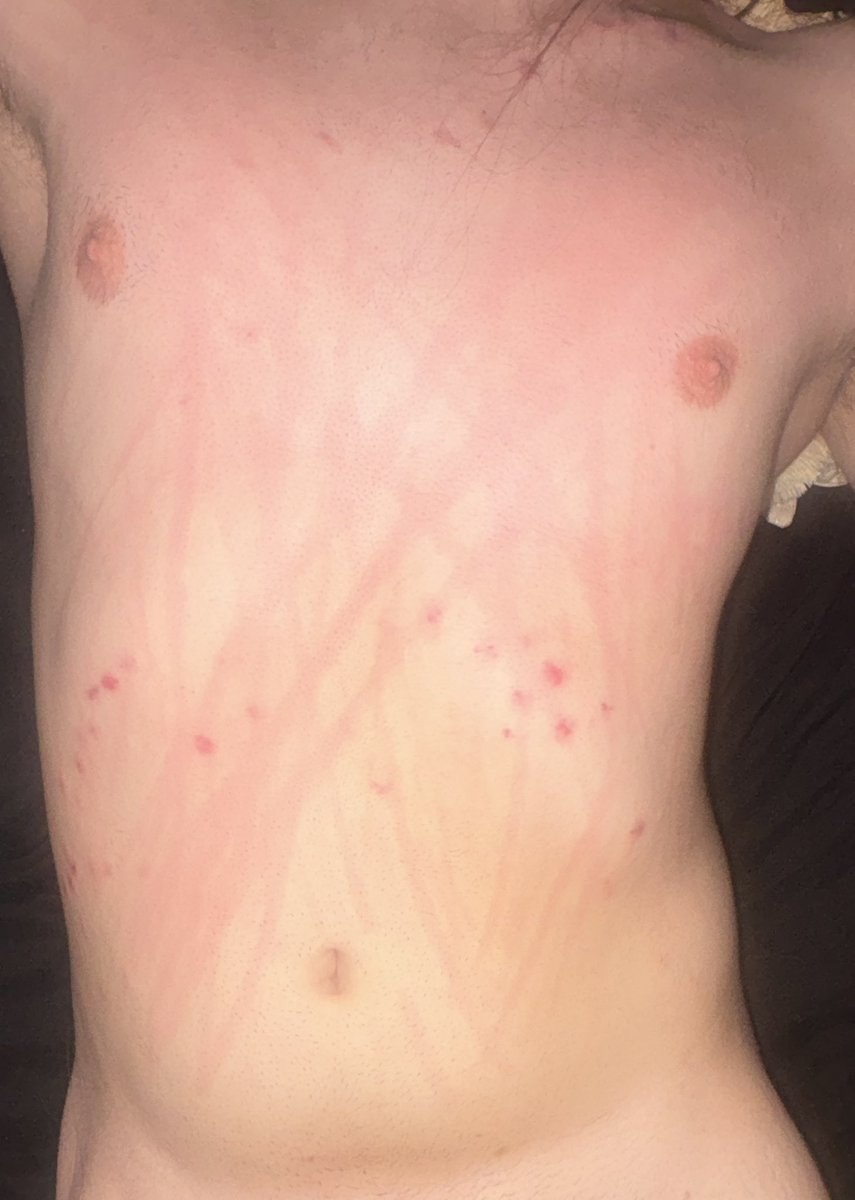 TimothyTheFoxAD's tweet photo. Did someone say tummy Tuesday?!?!? 
CW: Scratches #femboy #gay #masochisttwt https://t.co/HbYFwuDLYi