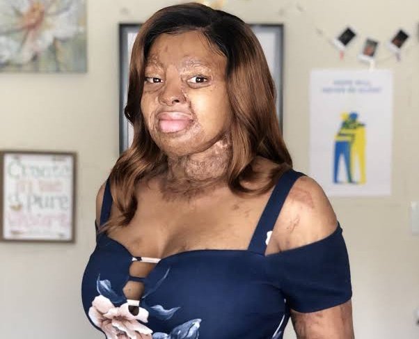 20 years ago today, the Sosoliso plane crash claimed 107 of 109 lives. 💔

Kechi Okwuchi, one of only two survivors, is a true symbol of strength and resilience!
