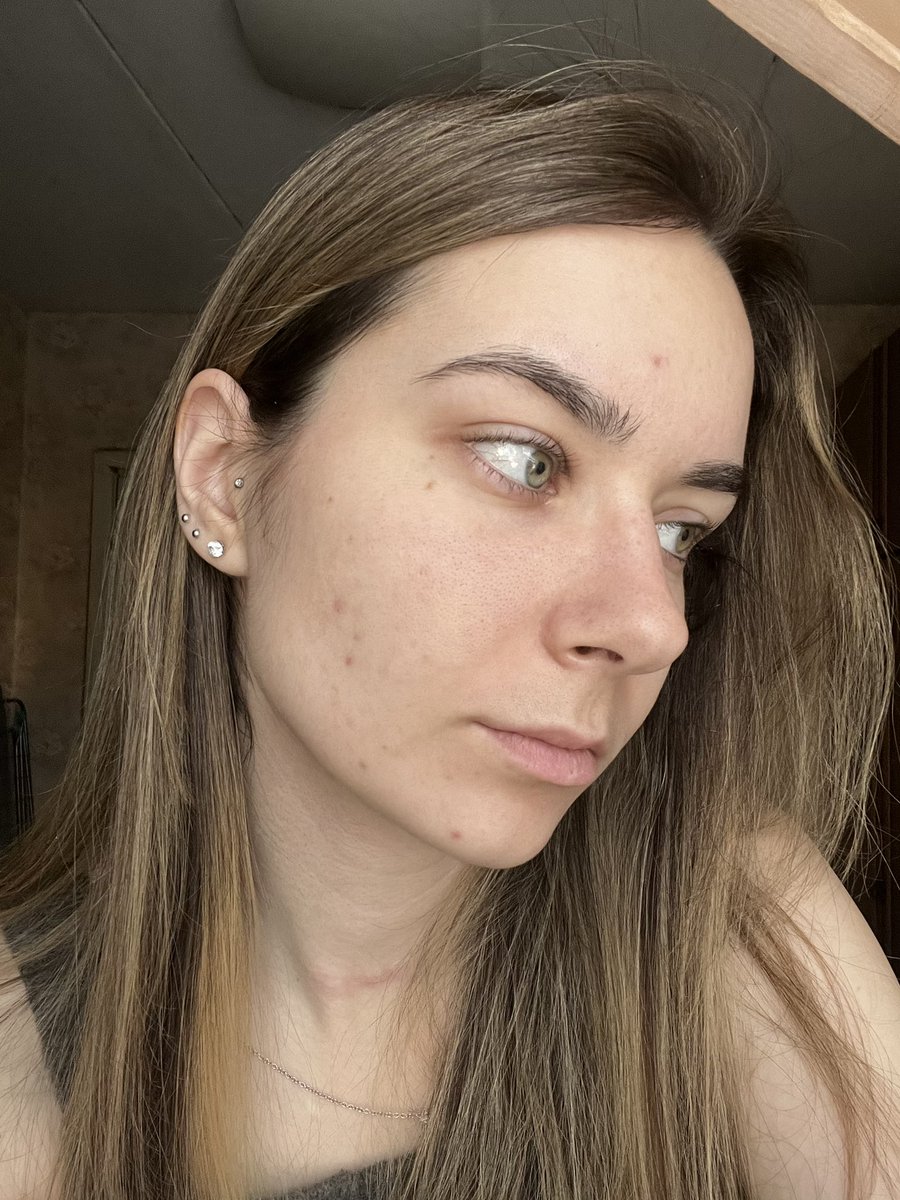 Ziganshaa's tweet photo. Декабрь 25го

на фото все выглядит не так плачевно, как в жизни 🥲
поменяла врача. пересадили с кислот на небезызвестный Эффезел (раньше им не пользовалась) https://t.co/AniO7Idhw8
