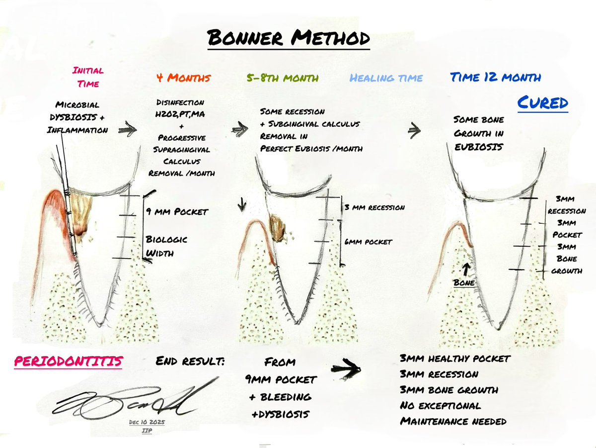 Curing periodontitis…easy
Need time and patient participation
And a microscopic dentist

doi.org/10.3389/fdmed.…