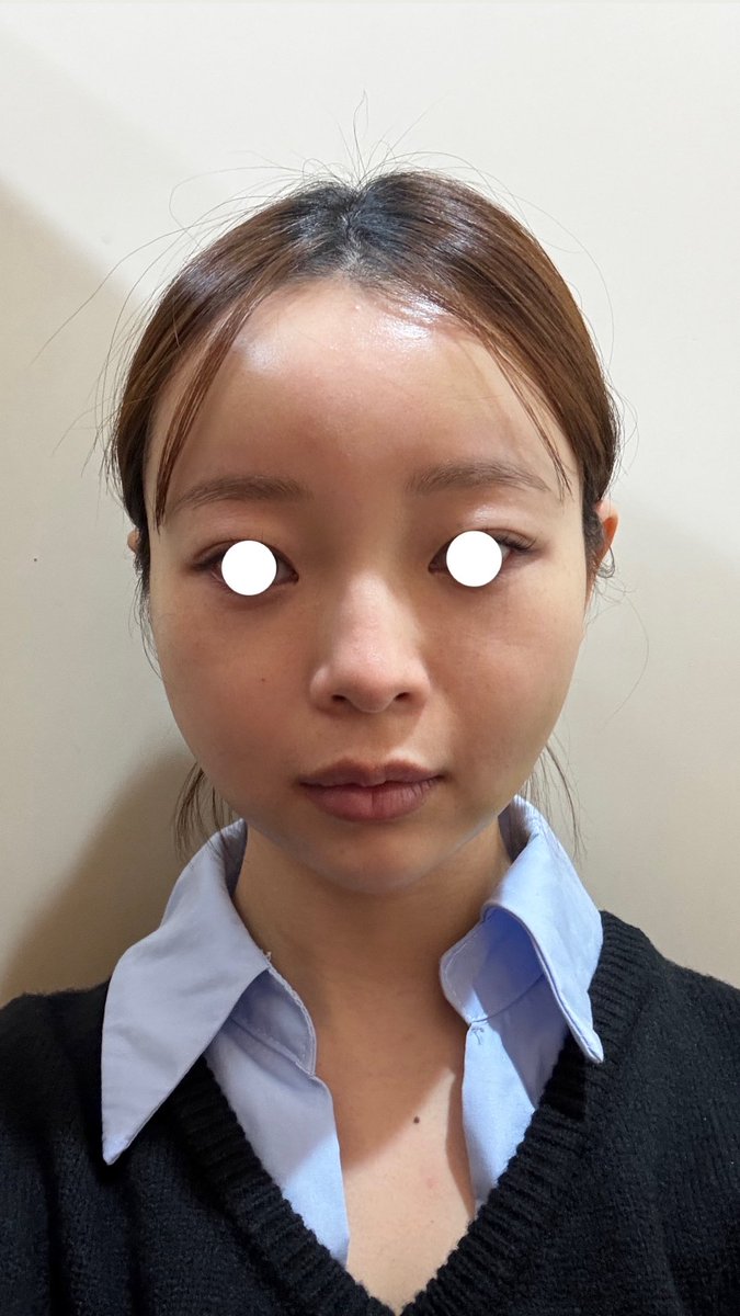 __04221205's tweet photo. トップフェイスさん🏥@topfacejp

・フェイスラインの脂肪吸引
・フルフェイス脂肪移植
・糸リ��ト6本 
・目の下脂肪再配置 

11/7に手術→4週間経過

左側はまだまだ腫れてますがだいぶスッキリ✨口元のアザも左側だけ完璧には消えてません…腫れが下に下がってきてるので順調みたいで完成楽しみ🌼 https://t.co/2hk9y6p1wW