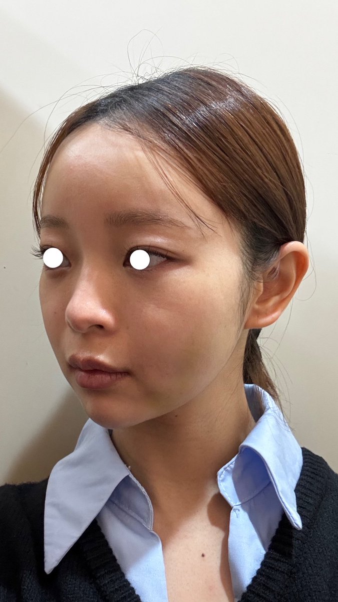 __04221205's tweet photo. トップフェイスさん🏥@topfacejp

・フェイスラインの脂肪吸引
・フルフェイス脂肪移植
・糸リ��ト6本 
・目の下脂肪再配置 

11/7に手術→4週間経過

左側はまだまだ腫れてますがだいぶスッキリ✨口元のアザも左側だけ完璧には消えてません…腫れが下に下がってきてるので順調みたいで完成楽しみ🌼 https://t.co/2hk9y6p1wW