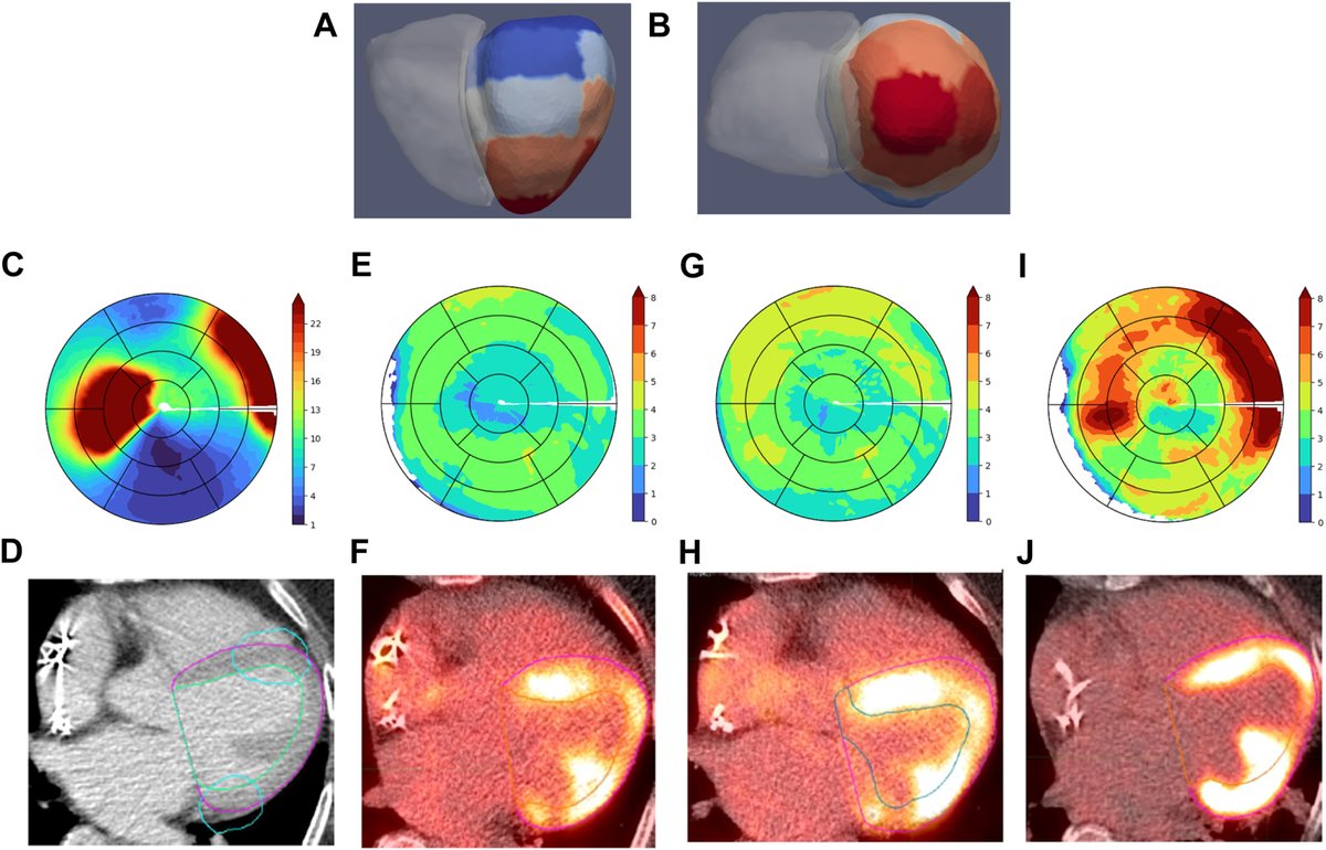 ASTRO_org's tweet photo. Read this #RedJounal article on longitudinal trends in myocardial metabolic uptake following stereotactic arrhythmia radioablation using 18FDG-PET/CT @gwalls89 @kaitlinmsmoore @alicardsdoc @pamelawoodardp @rentschlerlab @samsonpp @sbrt_cr @doctorphillep @carmenbergom https://t.co/mufFSF2ZLz