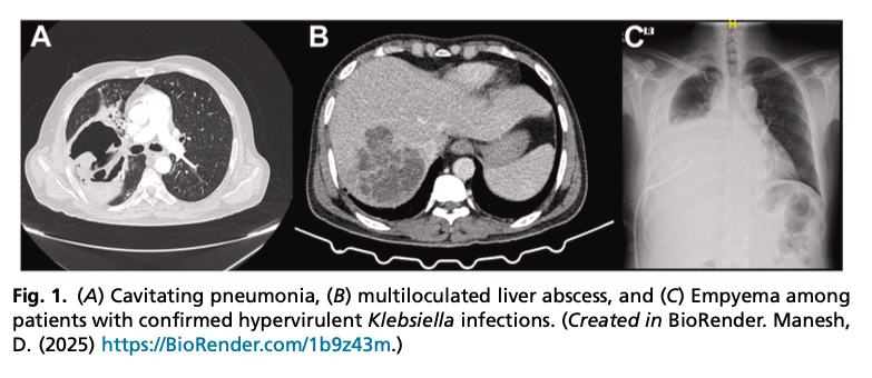 AliSMV7's tweet photo. Current Management Strategies for Hypervirulent Klebsiella

https://t.co/moVpGFGzKE https://t.co/6dStDrdyYU