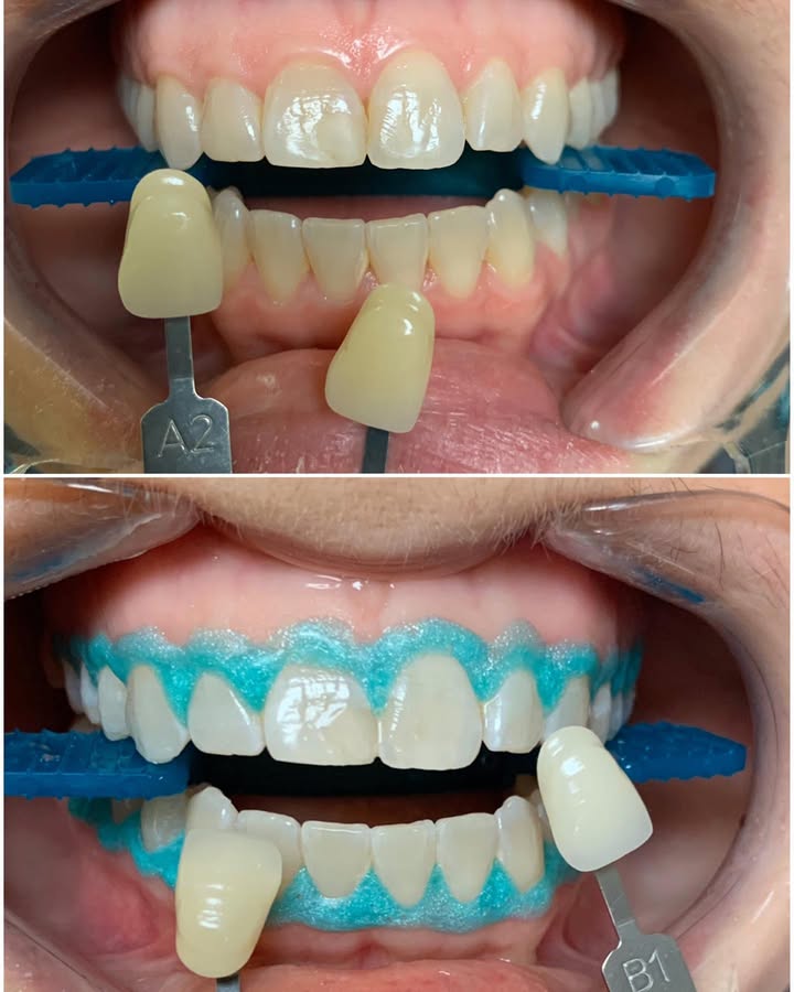 GlamorousGnnau's tweet image. Message me and ask about our in-office whitening! 😍❤️🦷🤩 In and out in one hour! #nofilters #noediting #whitening #bleaching #orangecity #floridadentist #dentist #cosmeticdentistry