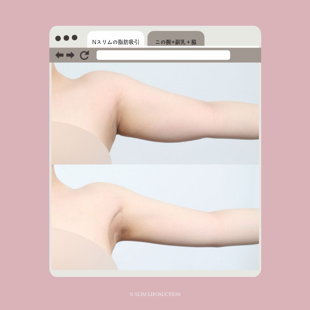 ＜Nスリムのニの腕脂肪吸引の特徴＞ 
①広範囲＆大容量脂肪吸引 
②360度どの角度から見てもすっきり
③見えにくい位置のシークレットゾーン＋目立たない傷跡 
④肌のたるみを抑え、ハリ、弾力まで考えた仕上がり

📷2200㏄吸入、162㎝、72kg 

☘️お問い合わせ
(日本語対応可能)
📲82-10-6771-4500