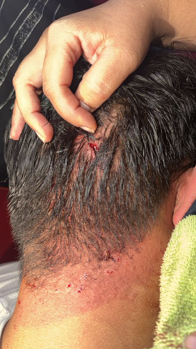juandiegozelaya's tweet photo. ¡Ya Basta! Continúa la violencia de colectivos de Libre en el CNE/INFOP.

Esta noche atacaron con morteros y bombas molotov un bus que trasladaba a nuestra gente de regreso a sus casas. 

Hay tres heridos; entre ellos Joseph Galdámez, quien debió ser ingresado al hospital por sus heridas. 

A pesar de estos hechos, nuestra gente se mantiene firme en el escrutinio especial para defender la democracia.

Hacemos un llamado urgente a las FFAA, Policía Nacional, Ministerio Público, Fiscalía de Derechos Humanos y CONADEH para que actúen de inmediato.

Asimismo, exhortamos a los observadores nacionales e internacionales a constatar lo que está ocurriendo.

El proceso post-electoral no puede ni debe desarrollarse bajo violencia. La democracia se defiende con ley, no con terror.