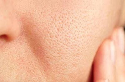 polarnight613's tweet image. Help your girlie out, how do you guys minimize open pores? 

I'm currently using facewash, moisturizer and sunscreen