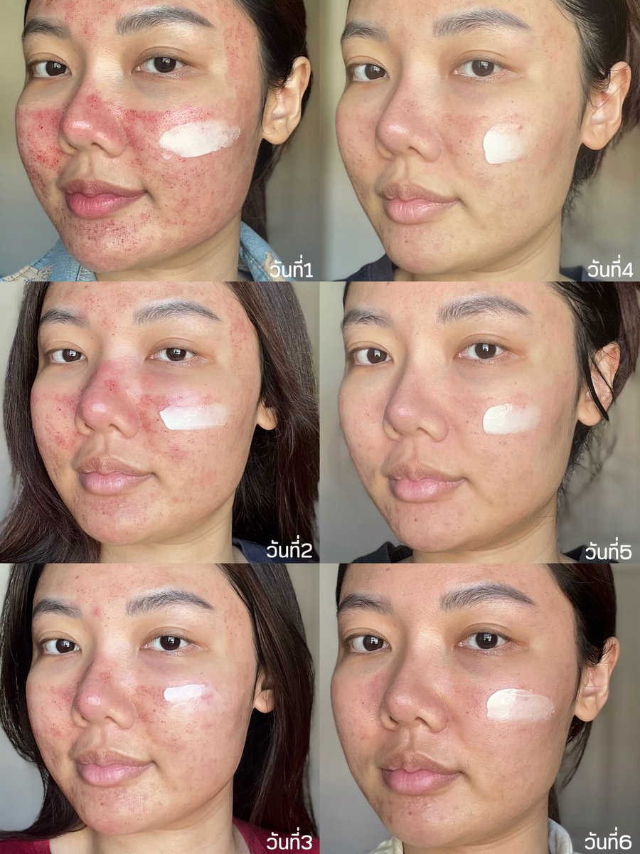 plengssp's tweet image. เป็นมอยส์ที่เหมาะกับผิวหลังทำเลเซอร์สุดๆ Pew&amp;amp;Co จุดเด่นคือมี egf ช่วยสมานแผลและกระตุ้นคอลลาเจน ทำงานร่วมกับ gold bonded vitaminC ที่อ่อนโยนมาก ยิ่งใช้หลังทำ pico คือแผลหายไวมาก และขวดเป็นสุญญากาศ มั่นใจได้ว่าทุกหยดสะอาดปลอดเชื้อ เหมาะกับใช้ช่วงผิวมีแผล ตอนนี้ใช้เป็น daily use…