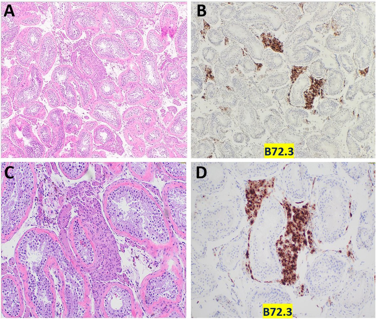 New in #HumPathol: B72.3 Serves as a New Diagnostic Marker for Testicular Leydig Cell Tumor. sciencedirect.com/science/articl… #pathology #PathTwitter #PathX #GUpath