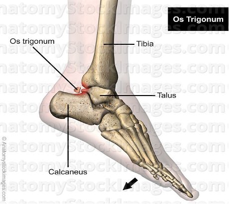 digitupbro's tweet image. פציעת יובאנוביץ׳
עצם אקססורית (מיותרת) בעקב כף רגל שמאל.
🔸המונח הרפואי: Os Trigonum
מדובר על חלקיק עצם המתפתח באספקט האחורי של עצם הטאלוס (talus) בכ-10-15% מהאוכלוסיה באופן נורמלי וללא תסמינים נלווים.
ברקדניות בלט הנדרשות לבצע תנועת point (כיפוף פלנטרי של כף הרגל) ולשאת על קצות…