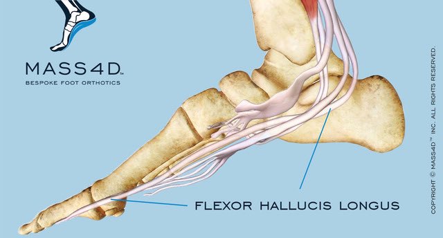 digitupbro's tweet image. פציעת יובאנוביץ׳
עצם אקססורית (מיותרת) בעקב כף רגל שמאל.
🔸המונח הרפואי: Os Trigonum
מדובר על חלקיק עצם המתפתח באספקט האחורי של עצם הטאלוס (talus) בכ-10-15% מהאוכלוסיה באופן נורמלי וללא תסמינים נלווים.
ברקדניות בלט הנדרשות לבצע תנועת point (כיפוף פלנטרי של כף הרגל) ולשאת על קצות…