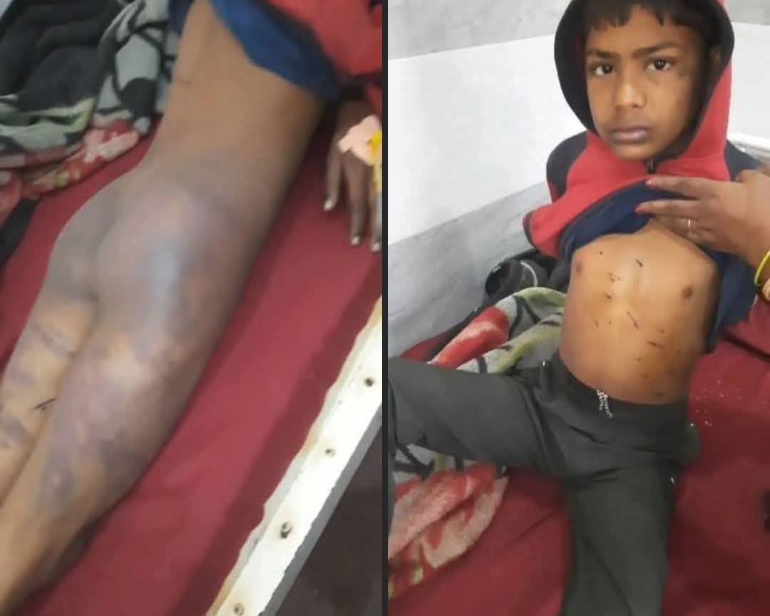 हमारे देश के कुछ तथाकथित जागरूक लोगों को दूसरे देशों में हो रहे अत्याचार तुरंत दिखाई दे जाते हैं,
लेकिन अपने ही देश में रोज़ बढ़ते ज़ुल्म उन्हें बिल्कुल नज़र नहीं आते।
यह तस्वीर किसी और देश की नहीं है।
यह बच्चा भारत का है।
यह बच्चा वाल्मीकि समाज से है।
हरियाणा के पलवल ज़िले के