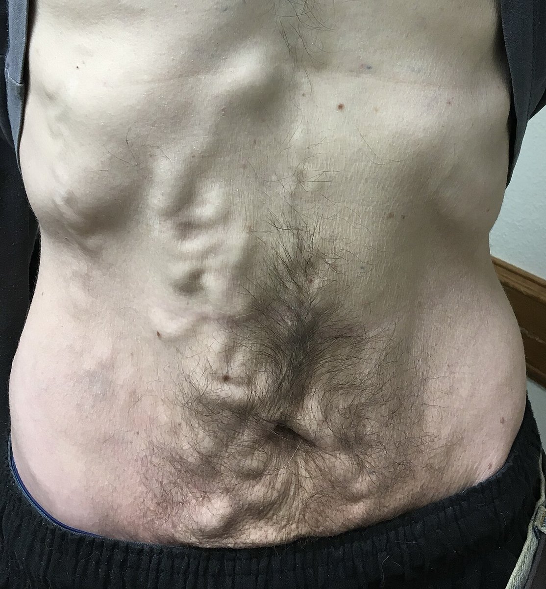 TrackYourHeart's tweet photo. Prominent dilated veins radiating from the umbilicus are best explained by:
A. Inferior vena cava obstruction
B. Recanalization of the umbilical vein
C. Splenic vein thrombosis
D. Right heart failure https://t.co/mgWR4Z2pkC