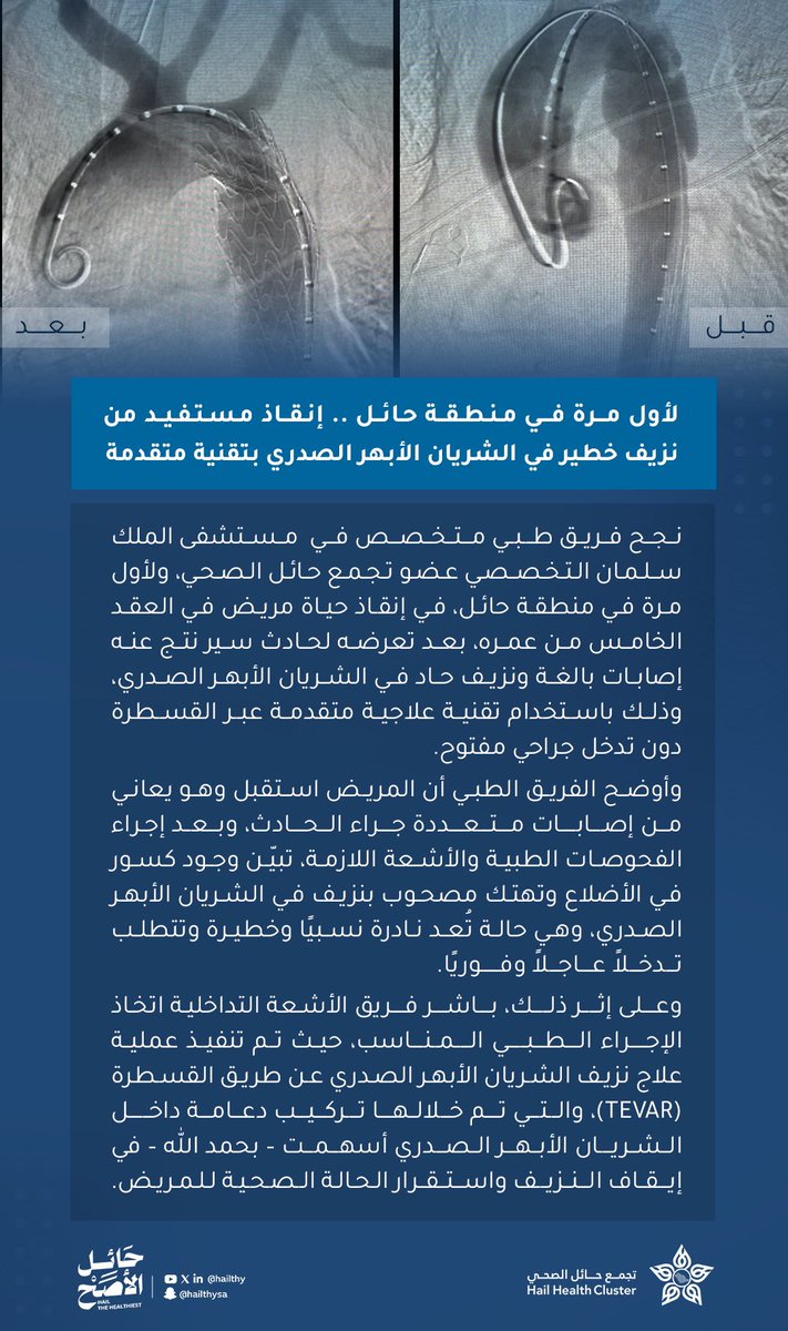hailthy's tweet photo. #لأول_مرة_في_حائل | ☝🏻

فريق طبي متخصص بـ #تجمع_حائل_الصحي يُنقذ مريضًا من نزيف خطير في الشريان الأبهر الصدري بتقنية متقدمة.

#حائل_الأصح https://t.co/l0EVTw1ozT