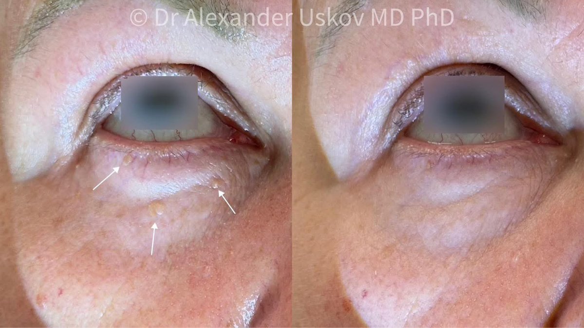 DoctorUskov's tweet image. Precise removal of periorbital skin tags using Dr. A.Uskov’s laser technique. Minimal disruption to surrounding tissue for a smoother eyelid contour.

#uskovprotocol #laseraesthetics #laserremoval #healthyskin #aesthetics #cosmetologist #laserprocedure