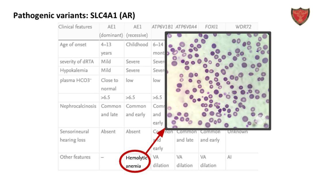 drsakshinephro's tweet photo. @SayaliBThakare 
#ISNCON2025
 Most common genotype in 🇮🇳 and Asia- SLC4A1-biallelic type
Rarest one is FOXI1- 4th case ever described till now was found during this study https://t.co/Q2ycpvnmh4