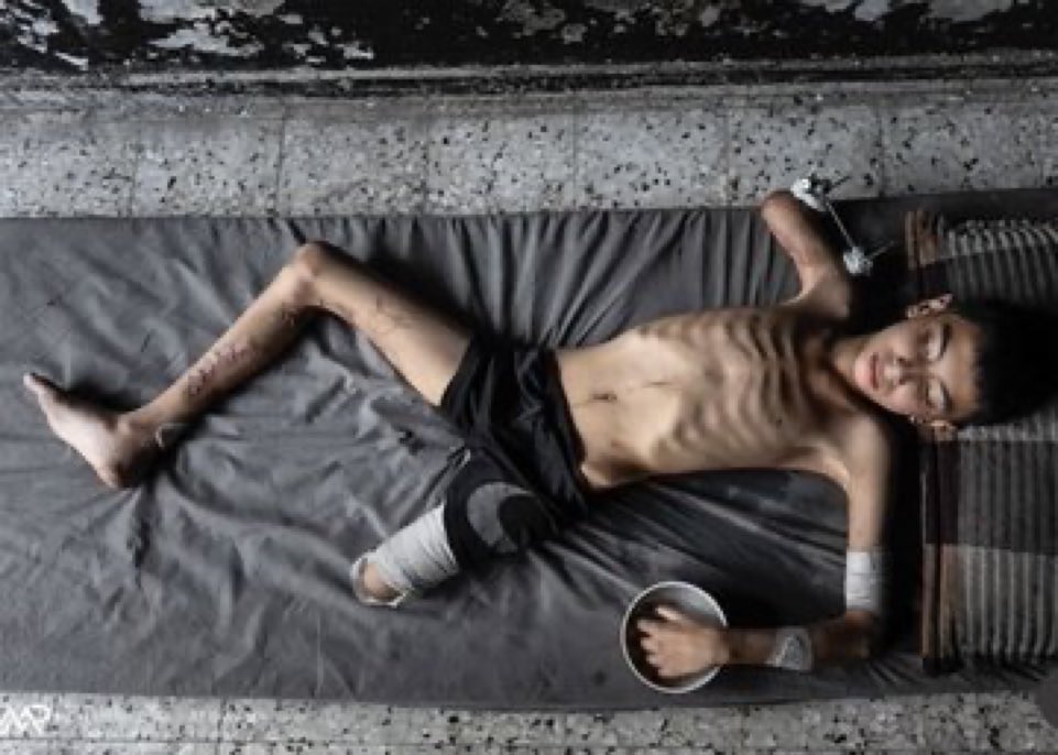 Gazze’de 50.000 çocuk yaralı ve çoğunluğu bir uzvunu kaybetti.

Ses etmeyen, karşı koymayan herkes İsrail’in suç ortağıdır!

"Dünya Şehit Çocukları Günü" 
 #TheReemsDay yazıyoruz