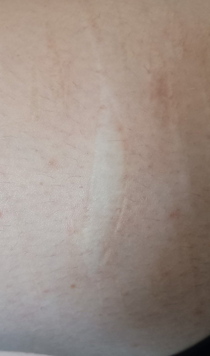 smalliette's tweet photo. tw/cicatriz

essa é a maior cicatriz, já tem uns 5 anos, eu acho, parece ser um pouco menor do que a da foto!
ignorem a perna com os pelinhos crescendo pfv. https://t.co/cCkSmKoKrB