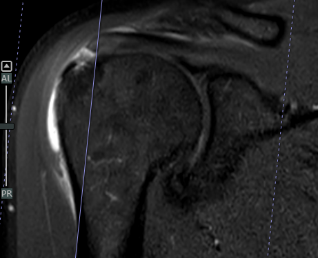 مريض يستعيد كامل حركة كتفه بواسطة تقنية طبية متقدمة في مستشفيات المانع بالخبر 