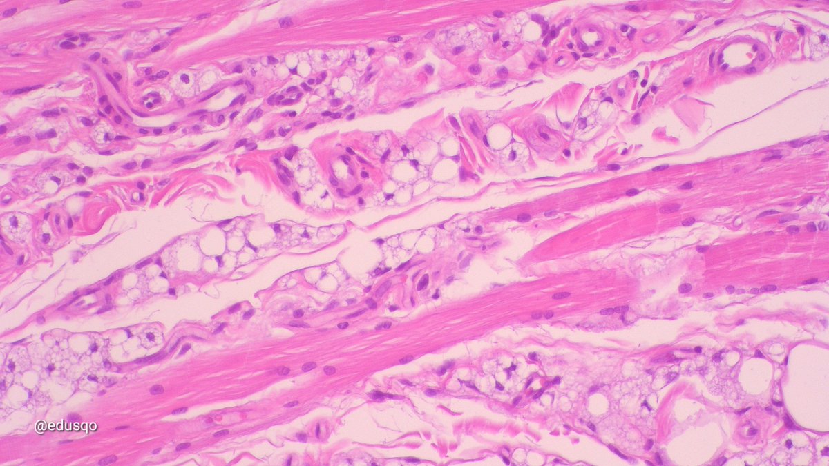 edusqo's tweet photo. Aging: bone resorption, atrophy, weakness...wrinkles 🫤
Fillers such as silicone enhances lip volume. Silicone vacuoles between muscle fibers, solar elastosis and BCC.
'We should not worry about wrinkles on our face, but about those in our brain'.
Santiago Ramón y Cajal
#DermPath https://t.co/8E94tTahXT