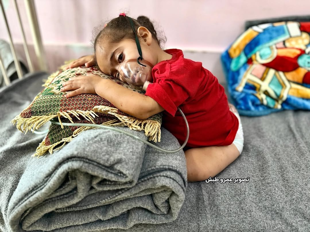 The child, Lana Za’rab, is in critical condition due to a rare inherited genetic disorder that has caused paralysis and left her dependent on oxygen to breathe. Doctors urge her immediate transfer abroad for treatment, as her life is at risk and cannot tolerate any delay.
To