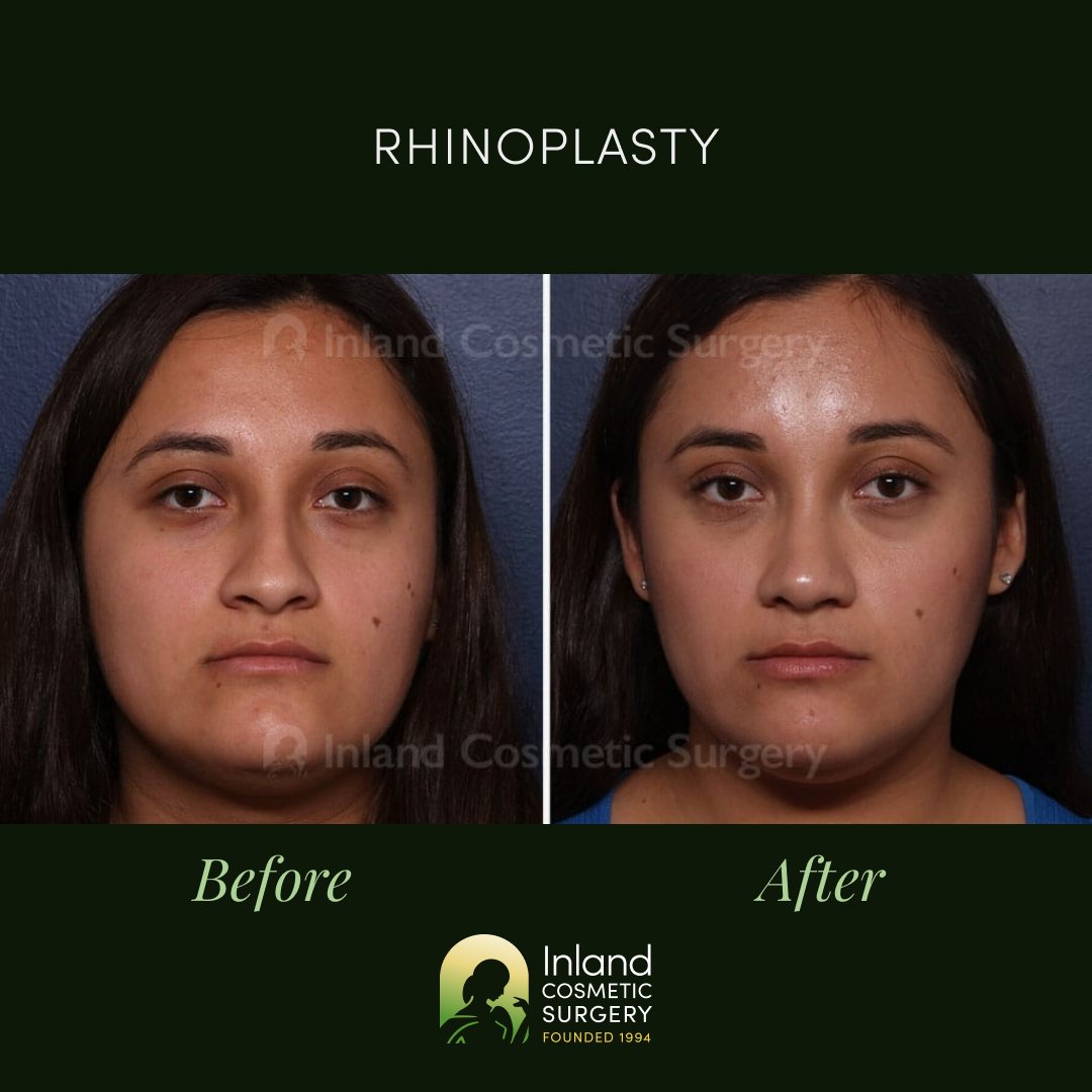 InlandCosmetic's tweet photo. This patient in her mid-20s is shown 1 year after rhinoplasty, septoplasty, and turbinoplasty, revealing a refined nasal profile, improved symmetry, and functional enhancements that help her breathe &amp; feel her best. https://t.co/FDFRg6l2nW