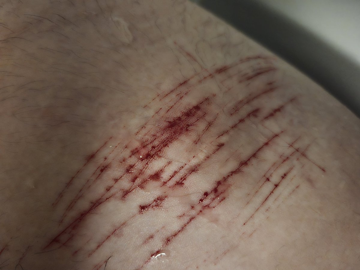 AngelicCrypti's tweet image. [Sfx makeup] catscratches on my ugly fat thighs